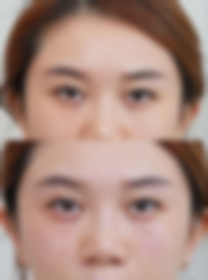 五、注射瘦脸针的注意事项