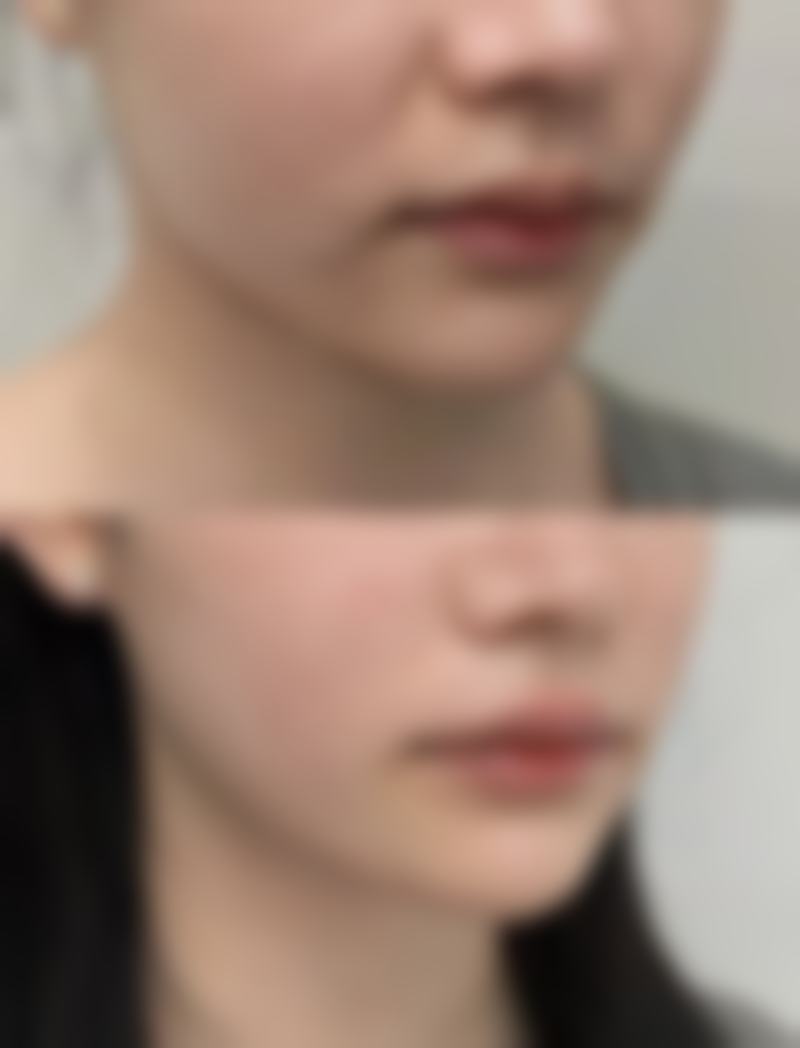 四、去眼袋手术的风险