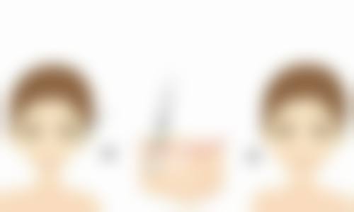 四、非手术去眼袋的注意事项:眼袋不手术可以去除吗的保护要点