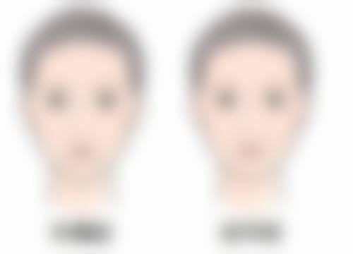 一单一双眼皮是什么原因造成的？先天发育、水肿、皮肤松弛或是主因