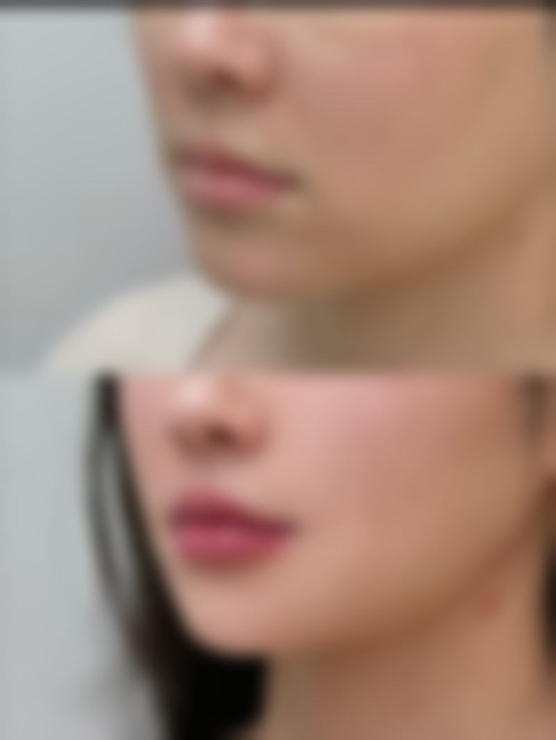 二、轻度眼袋的祛除方法