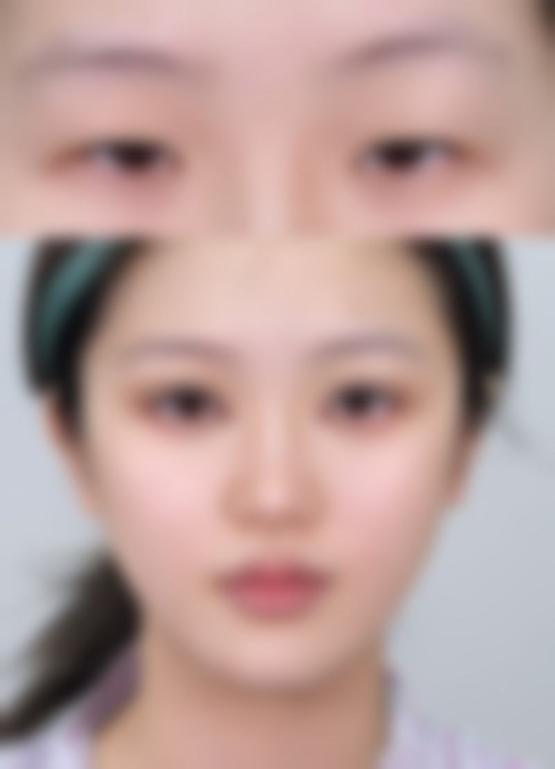 三、日常护理对多年凹疤痕的重要性