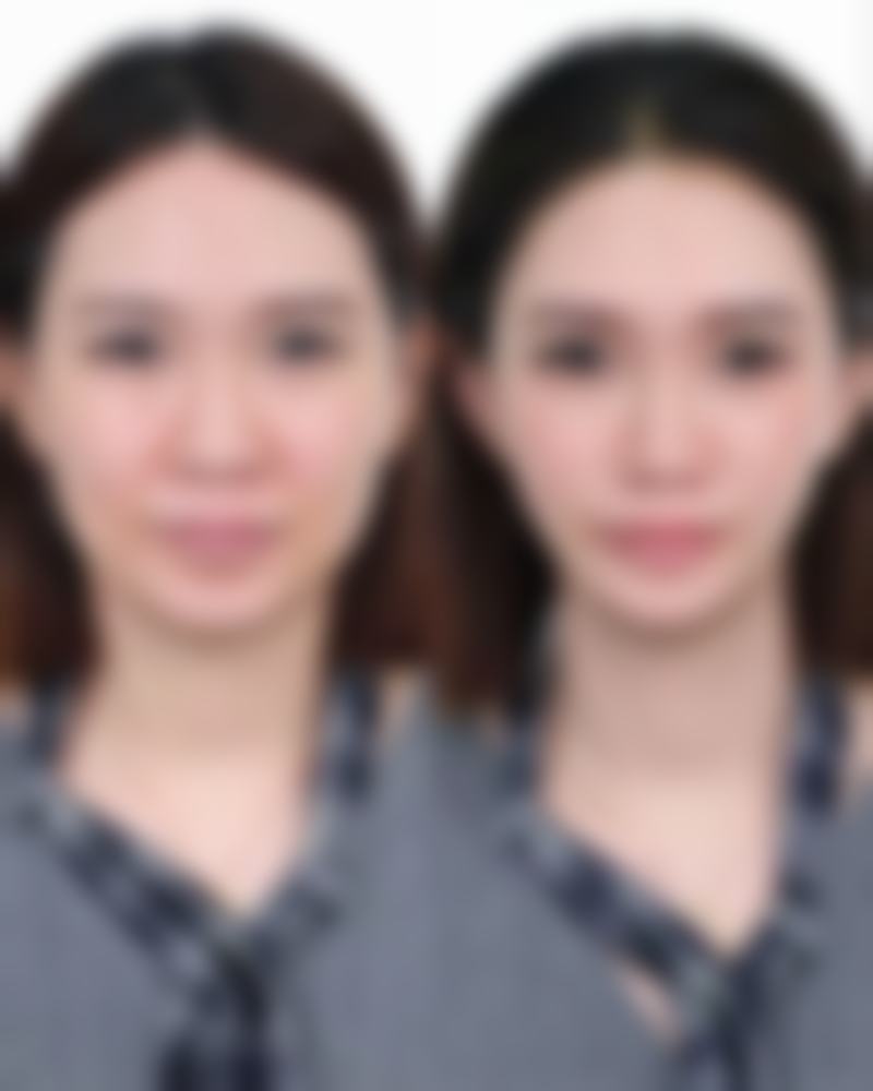 一、认识眼袋