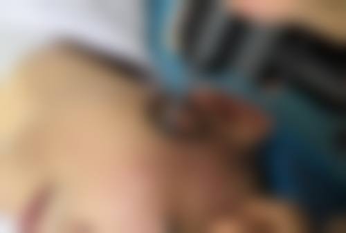 四、眼袋可以用按摩的手法去除吗?重度眼袋的医疗干预
