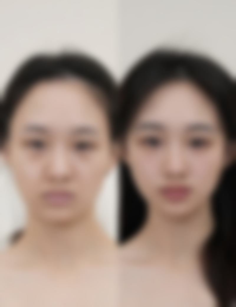 三、物理疗法消掉熬夜的眼袋