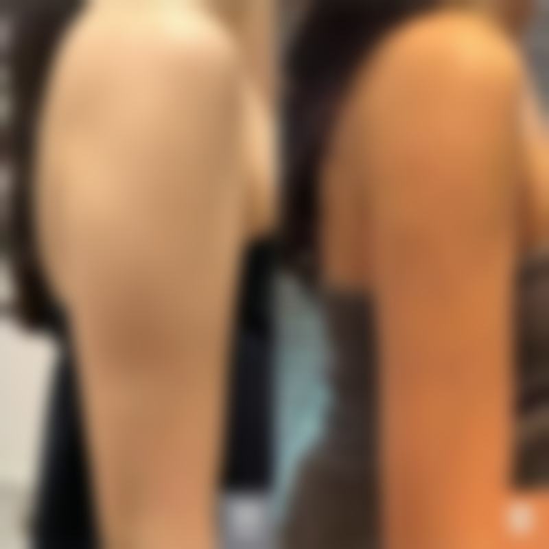 二、疤痕色素沉淀的治疗方法