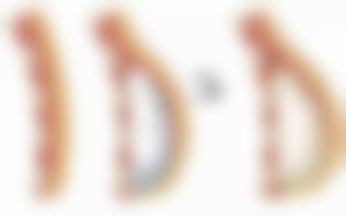 三、改善男士眼袋皱纹重度的医美方法