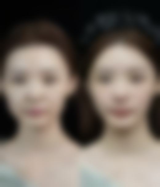 一、做了双眼皮多久可以化妆?埋线双眼皮情况分析