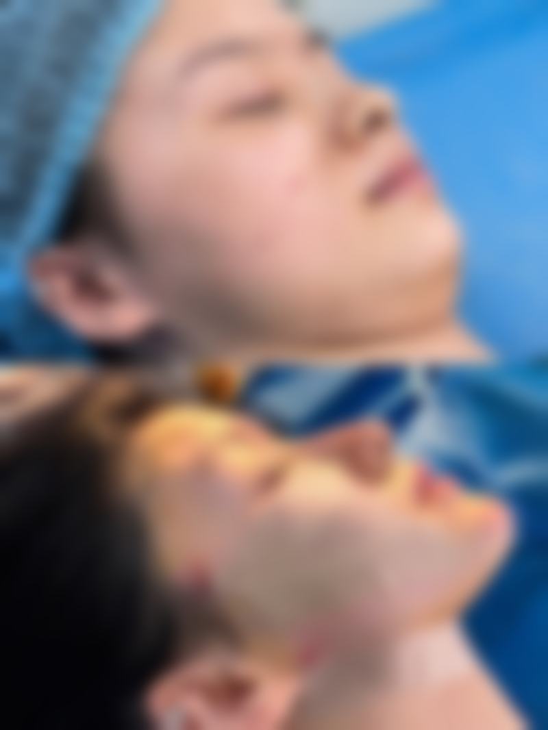 五、凹形疤痕修复的成效因人而异