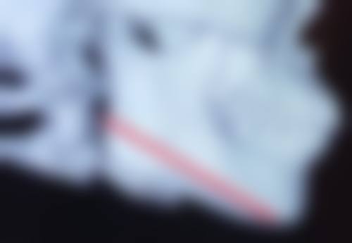 三、吸脂隆胸能维持多久之术后护理的影响