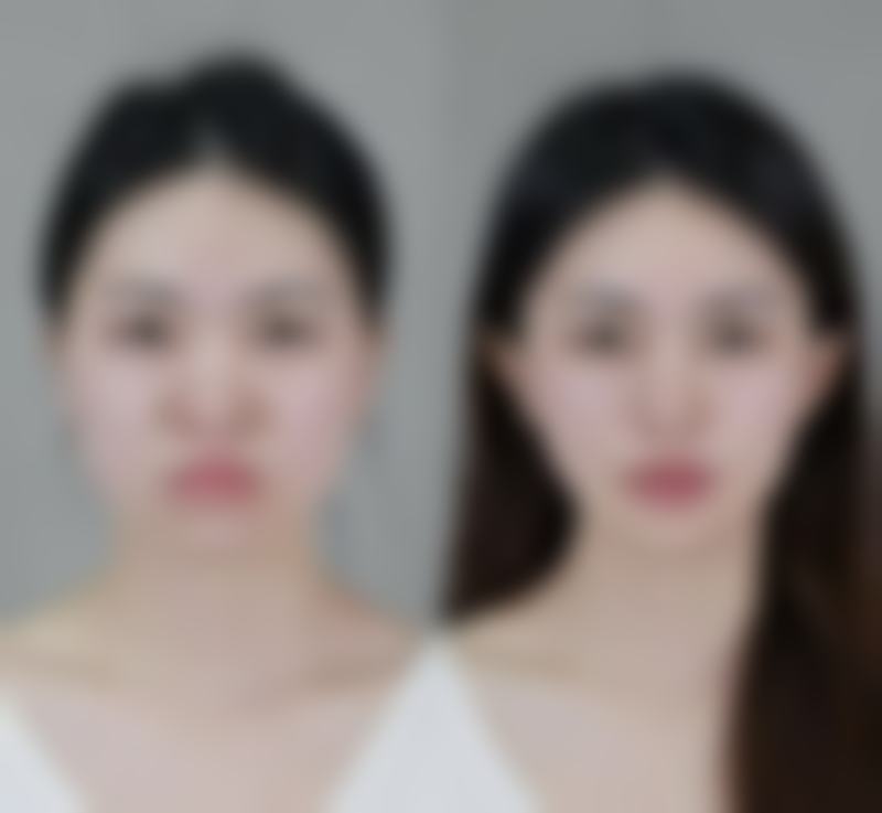 一、botox除皱成效揭秘