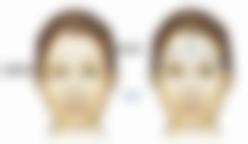 四、疤痕体质者双眼皮手术的术前准备