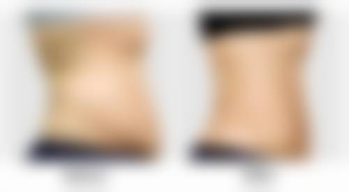 四、隆胸有生命危险吗?如何降低手术风险
