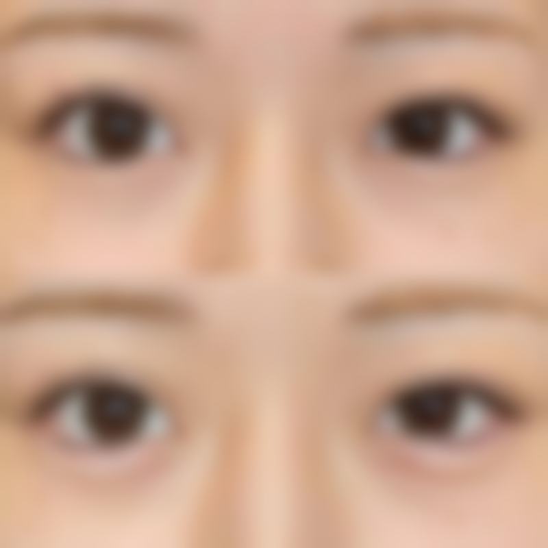 疤痕体质能整双眼皮吗？了解合适术式、做好护理也能拥有自然双眼皮！ 
