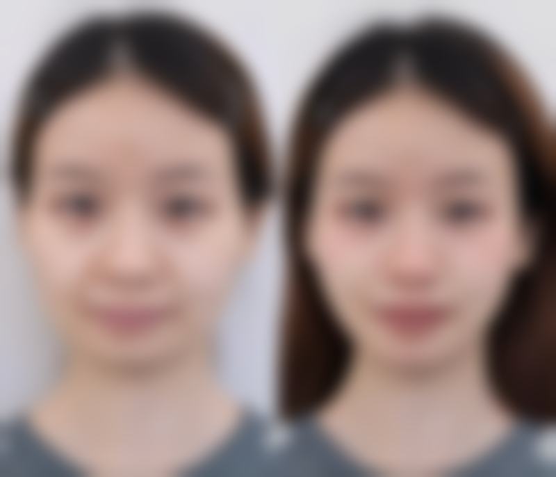 三、去眼袋之药物治疗法