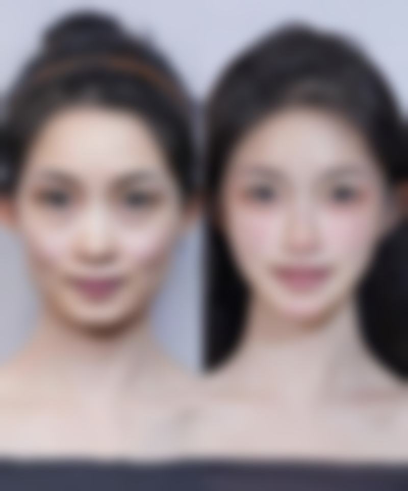 五、大腿抽脂成效显现后的注意事项