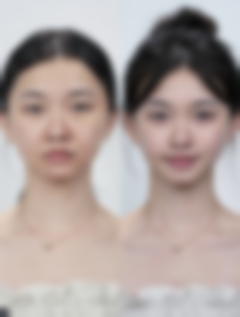 三、大腿抽脂后不同阶段的变化
