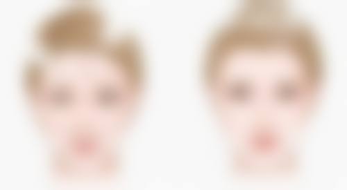 四、双眼皮手术后疤痕修复的注意事项