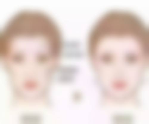 三、手术治疗凹陷疤痕的方式及成效