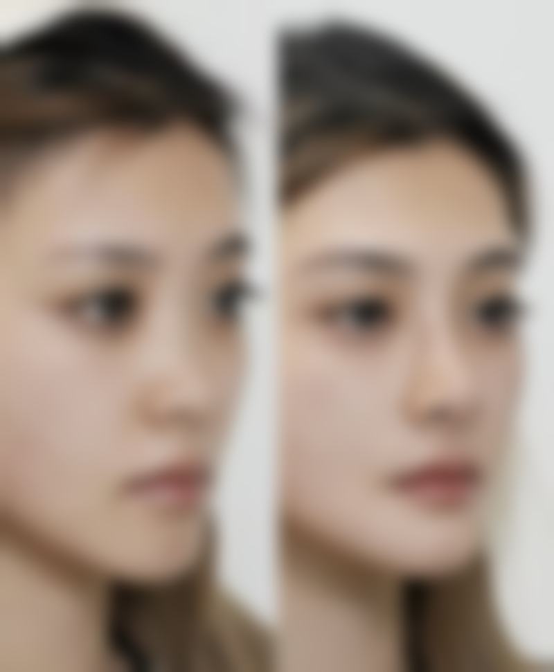 三、抽脂更多一次可以抽多少的影响因素