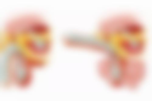 二、双眼皮眼角开小了的处理方法
