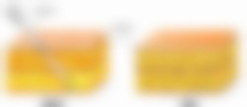 三、不同阶段全切双眼皮瘢痕的表现