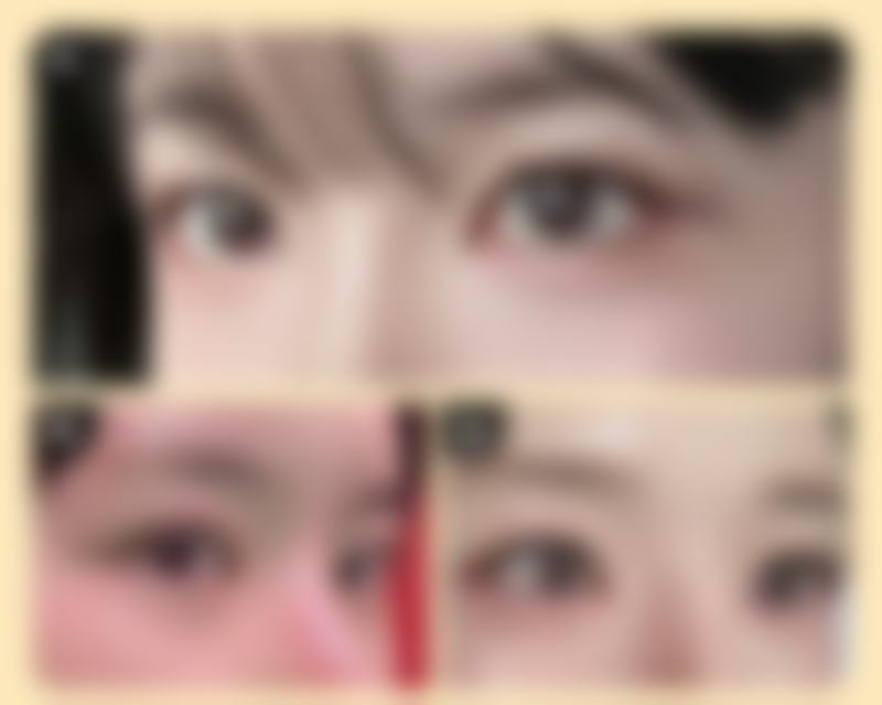 四、双眼皮眼角开小了的心理调节