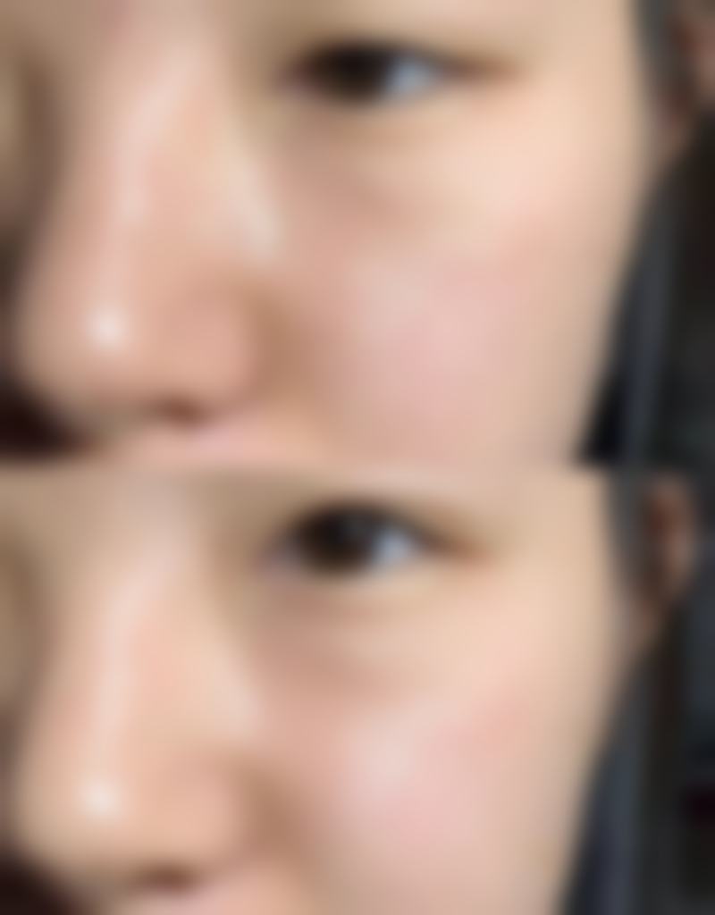 三、吸脂对身体出现栓塞的可能性