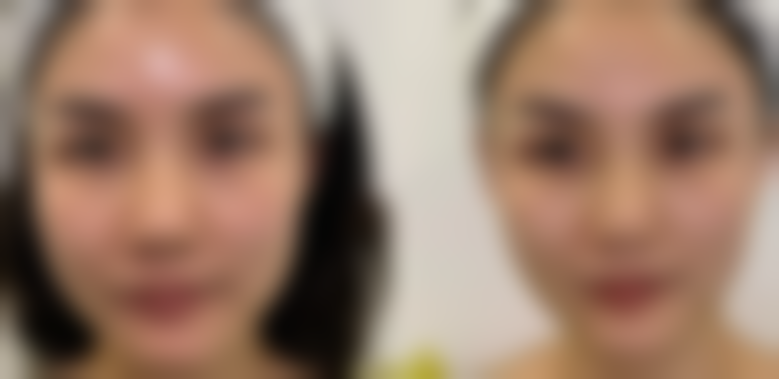 双眼皮眼角开小了怎么办？掌握这些方法助你快速恢复、改善眼部效果