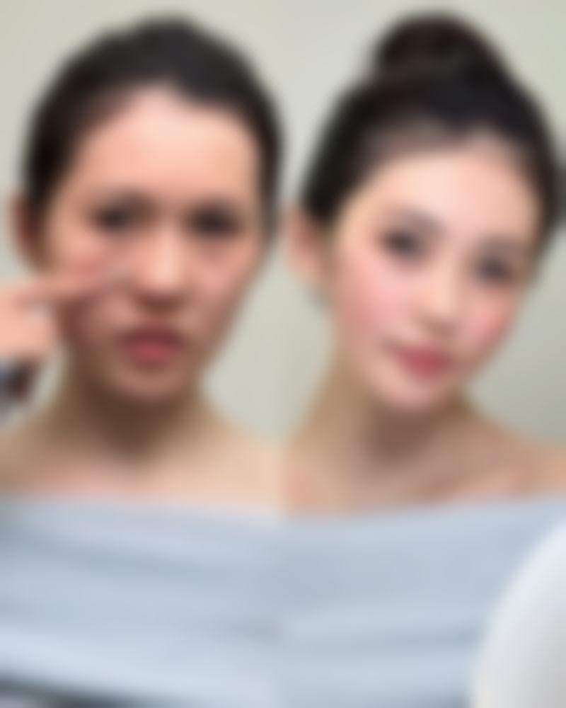 二、疤痕增生会自己长平吗?看看自然消退过程