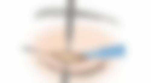 四、自体脂肪填充太阳穴的术后护理要点