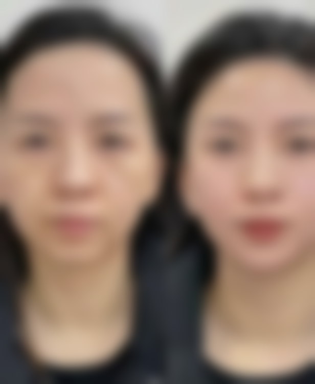 一、丰太阳穴的常见方式——自体脂肪填充