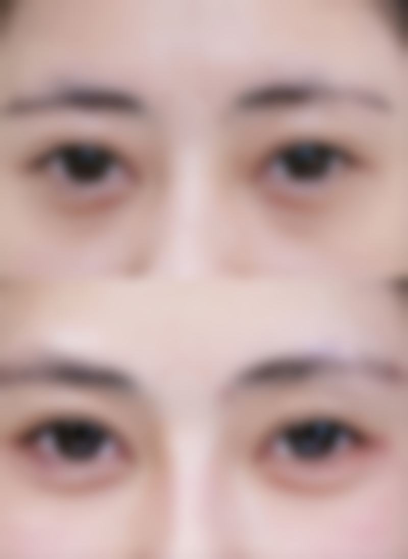 五、快速去掉疙瘩疤痕之激光治疗