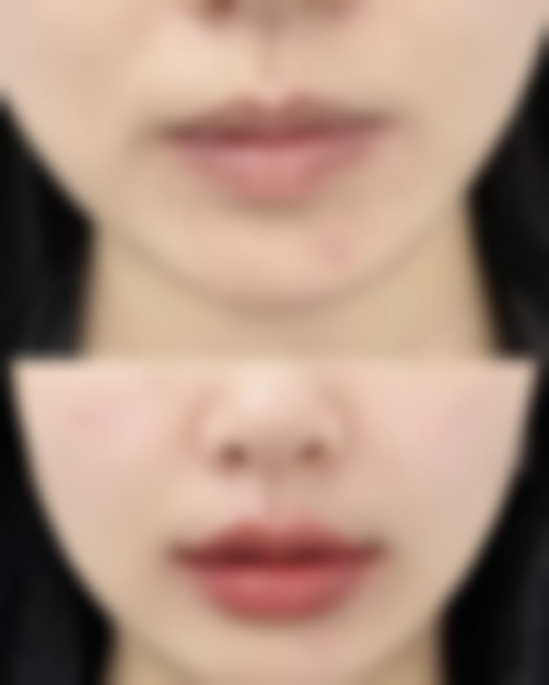 一、手术刀口疤痕修复时间的大致范围