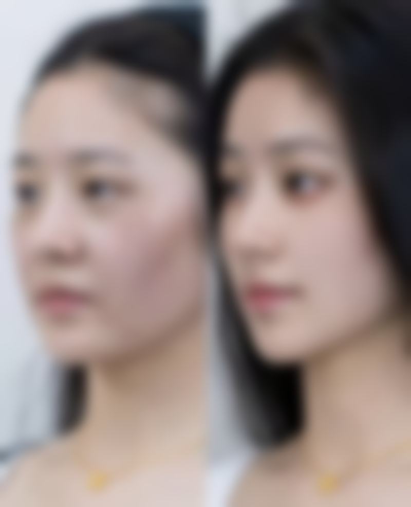 四、打完除皱针后敷面膜的注意事项