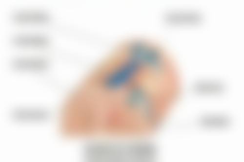 四、眼袋手术后有疤痕吗?如何预防和处理疤痕