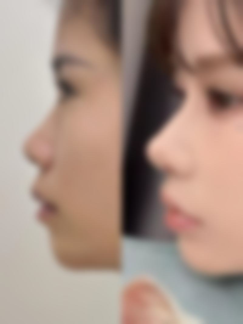 三、影响去眼袋手术修复时间的因素