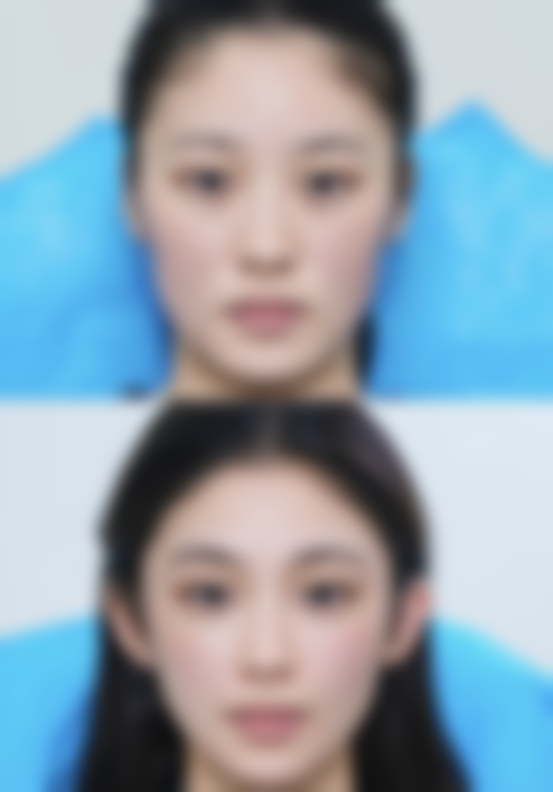 三、做眼袋一定要填泪沟吗——做眼袋需要填充泪沟的情况