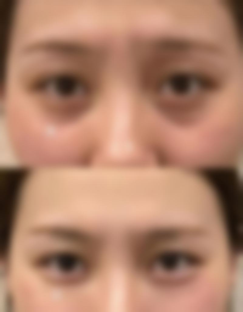 二、眼袋手术后有疤痕吗?不同术式的疤痕特点