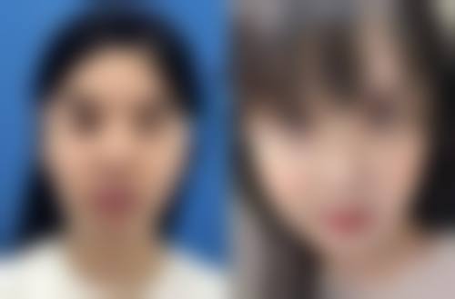四、双眼皮埋线手术的优缺点及对维持时间的影响