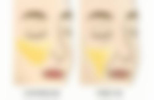 四、遗传性眼袋切除后复发的处理方法