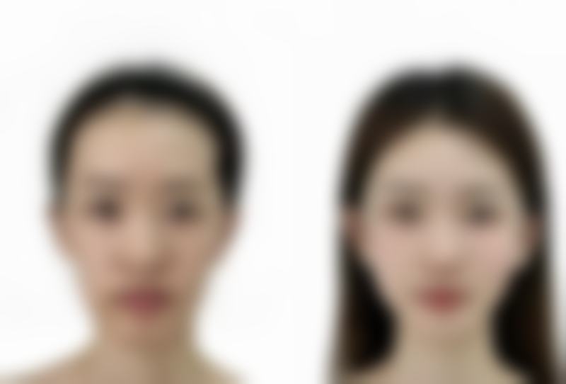 眉骨高做双眼皮好看吗?