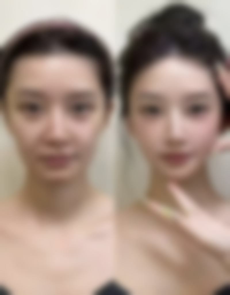 二、影响眉骨高做双眼皮成效的多元因素