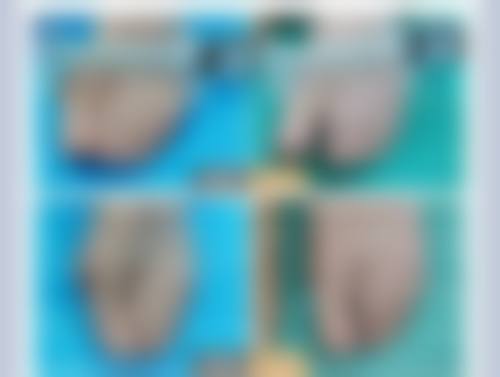 打瘦脸针可以维持多久时间？一次注射效果时长受药物、代谢、护理多因素影响 