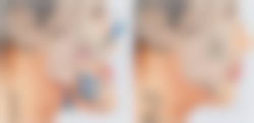 一、眼睛凹陷的成因与影响