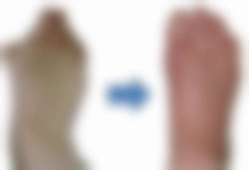 四、硅胶隆鼻的优缺点