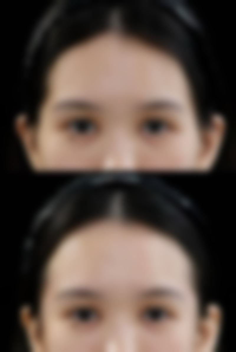 六、肋软骨隆鼻的修复和护理