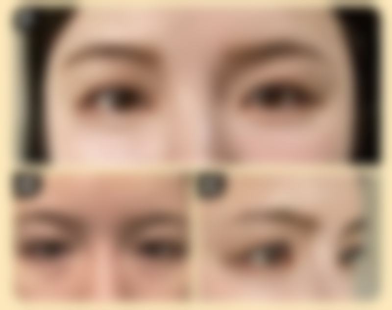 二、眼袋有汗管瘤之电灼术