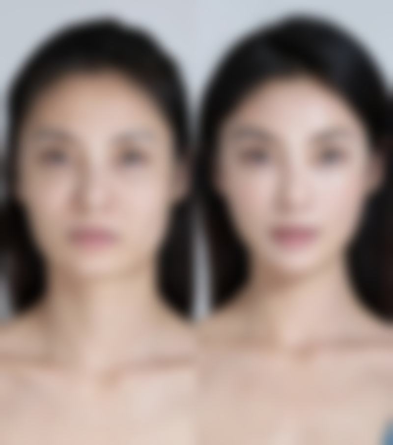 五、肋软骨隆鼻与假体隆鼻的对比