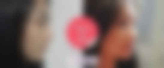 必妩整形外科高海燕医生面部吸脂太牛了 术后下颌线清晰双下巴消失气质精致